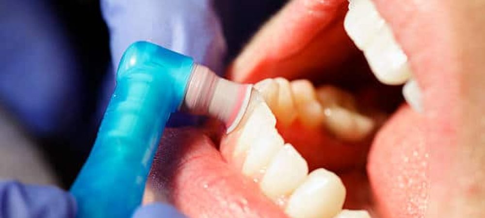Close-up of a dental professional polishing a patient's teeth with a rotary tool during a dental cleaning.